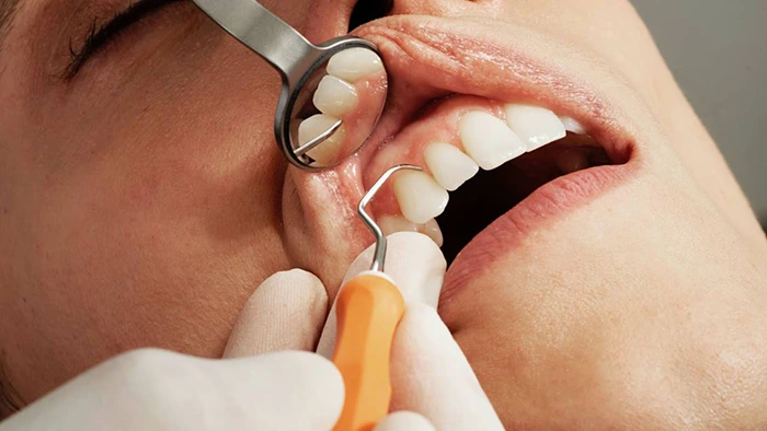 Periodontia: A Especialidade que Cuida da Saúde das Gengivas e Ossos